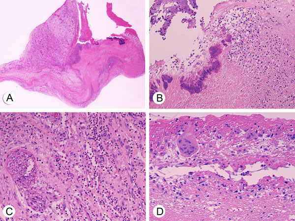infective endocarditis histology